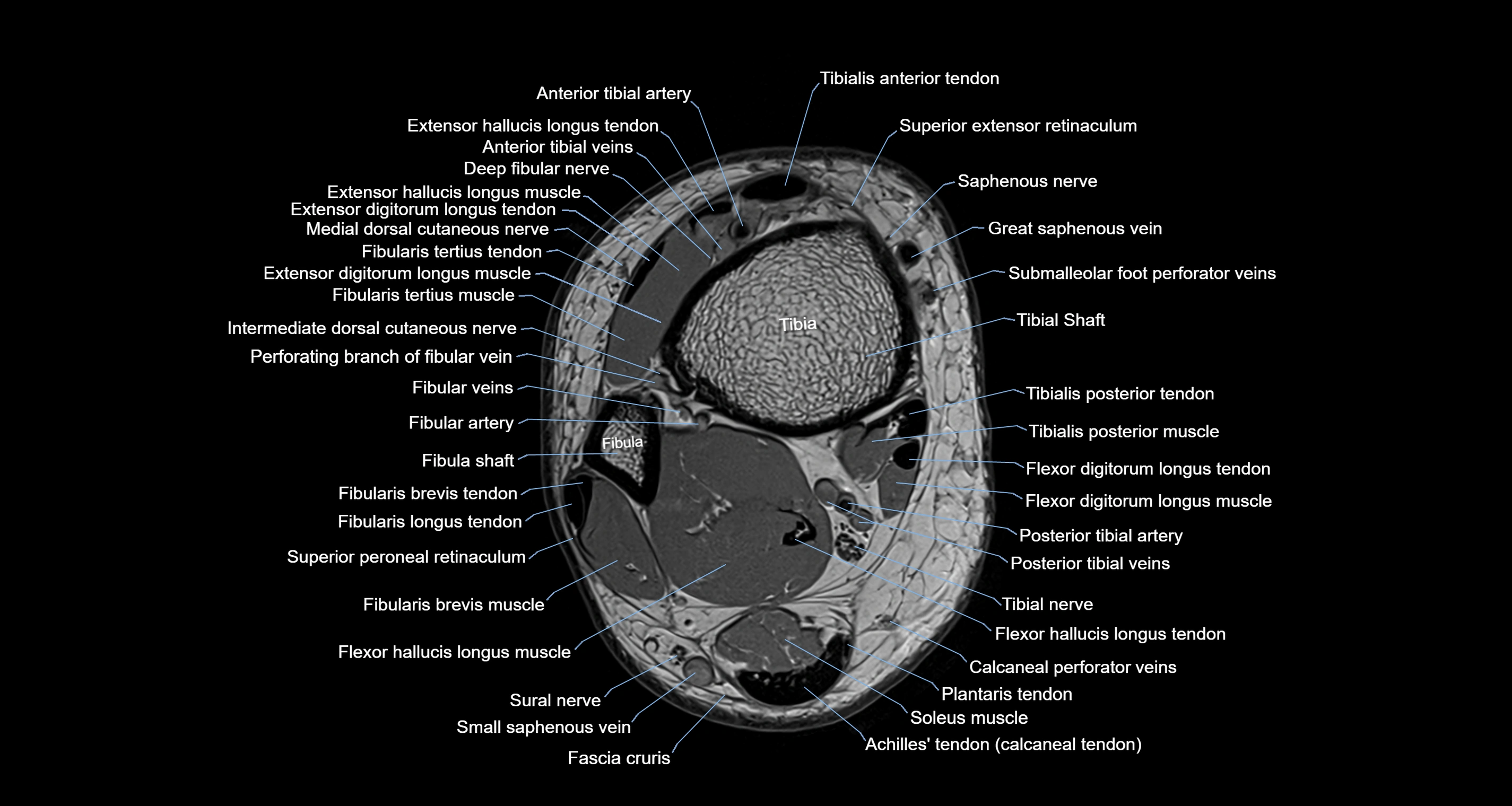Ankle axial anatomy 3T MRI images -img-10001-00001.webp